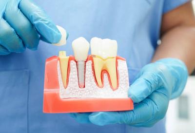 Dental Crowns Service Available in Mt. Roskill, Auckland